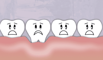 Can Your Gums Grow Over Your Braces?