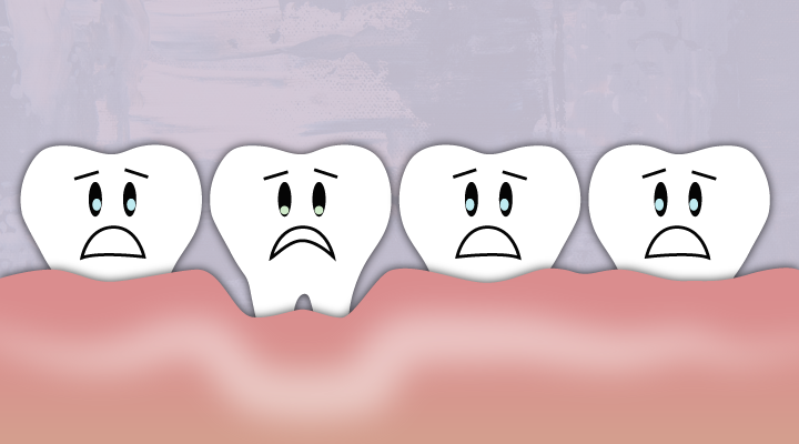 Braces can cause changes in the mouth that can look like gums growing over your braces! Click to learn about gum inflammation and swollen gums with braces.