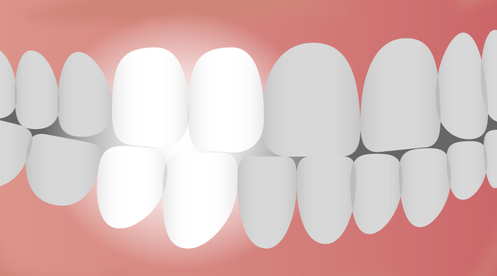 The bicuspid tooth is sometimes called a premolar because of its positioning between the canine teeth and molars.