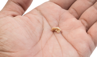 Person holding a tonsil stone.