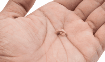 Person holding a tonsil stone.