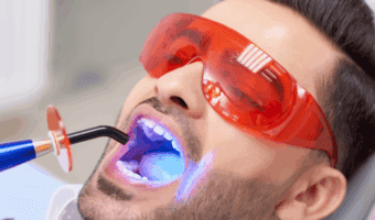 Person getting dental sealants applied to their teeth.
