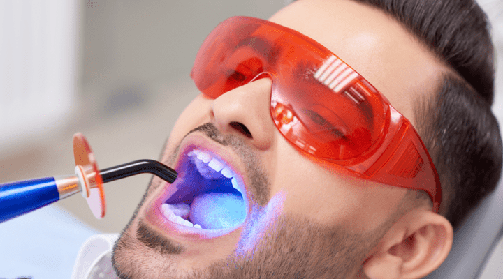 Person getting dental sealants applied to their teeth.